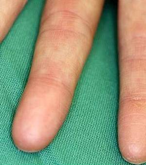 Sujet atteint d'adermatoglyphilie